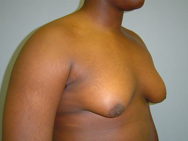 male breast reduction patient