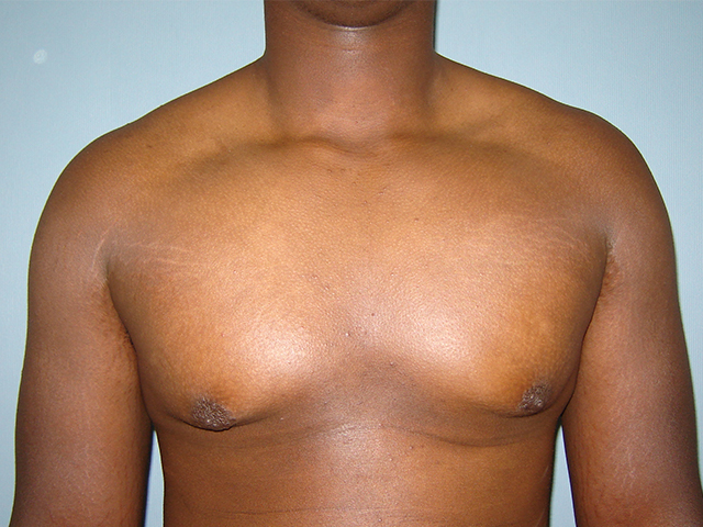 male breast reduction patient