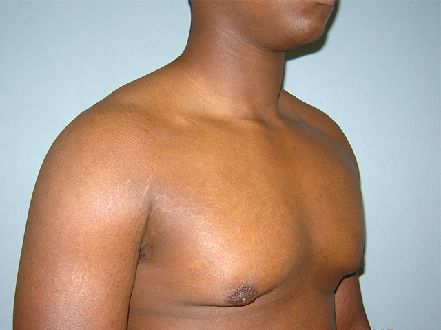 male breast reduction patient