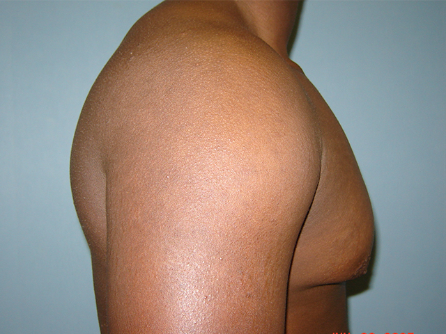 male breast reduction patient