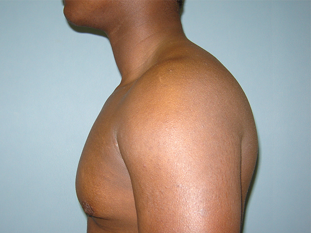 male breast reduction patient