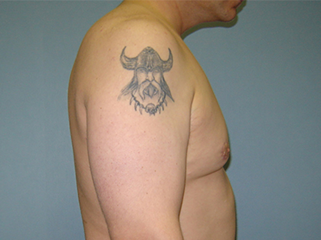 male breast reduction patient