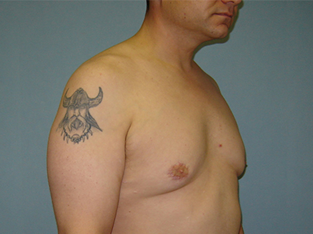 male breast reduction patient