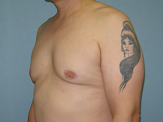 male breast reduction patient