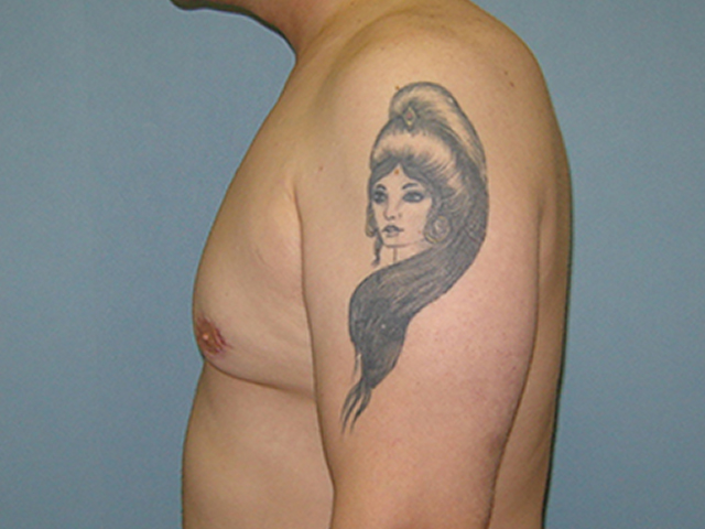 male breast reduction patient