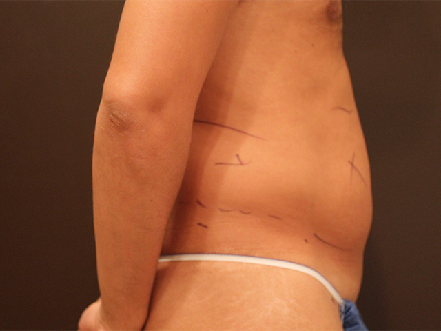 male liposuction patient