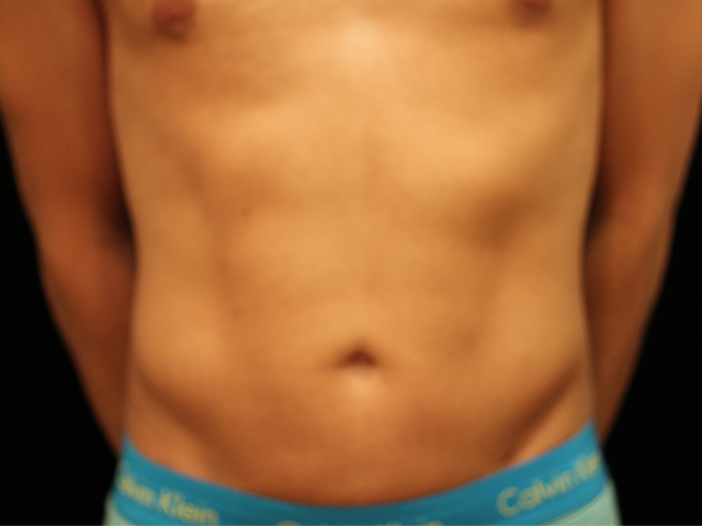 male liposuction patient