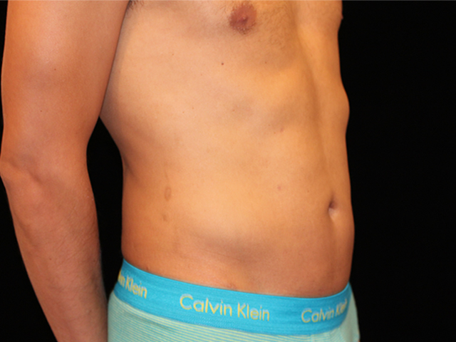 male liposuction patient