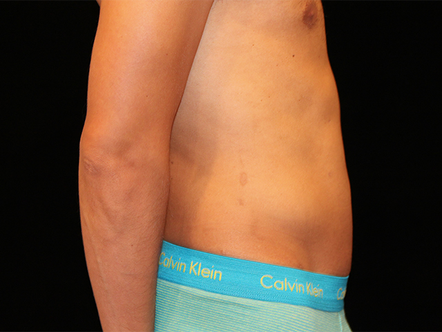 male liposuction patient