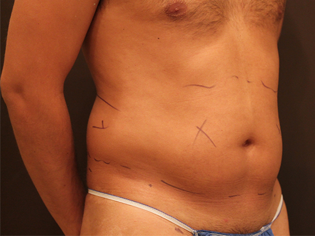 male liposuction patient