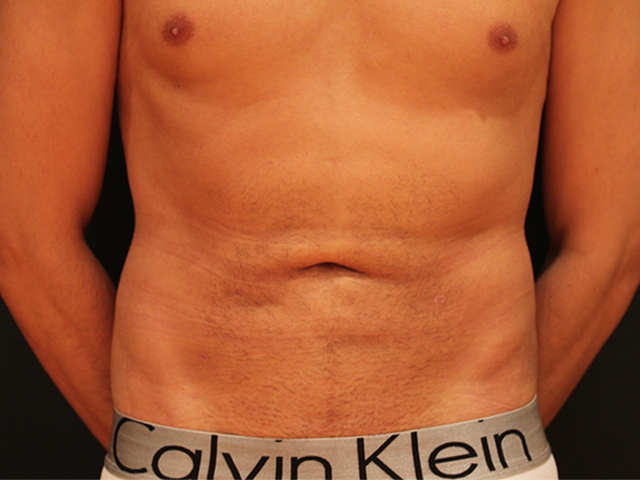 male liposuction patient