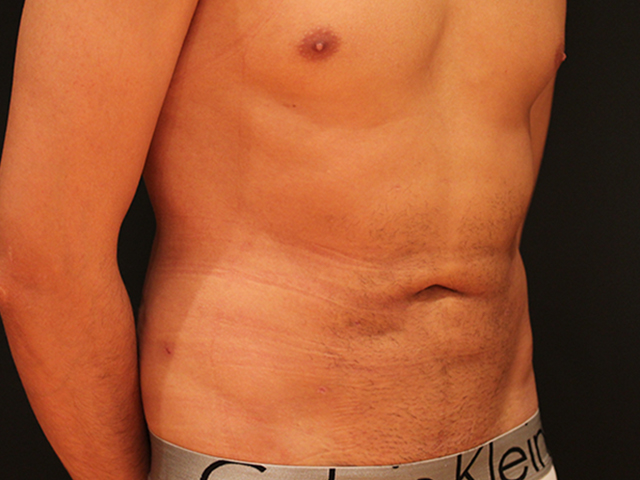 male liposuction patient