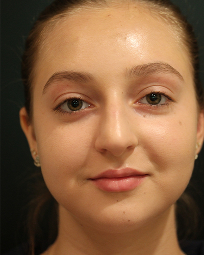 rhinoplasty patient