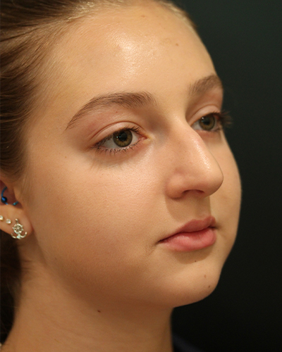 rhinoplasty patient