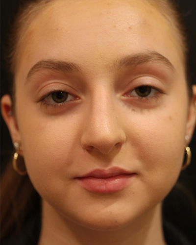 rhinoplasty patient