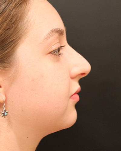 rhinoplasty patient