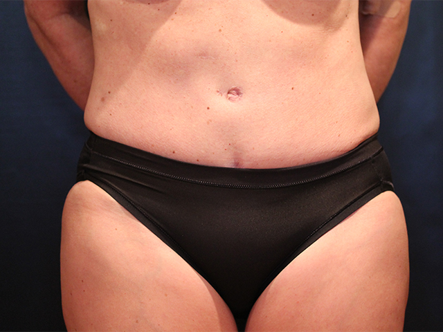 tummy tuck patient