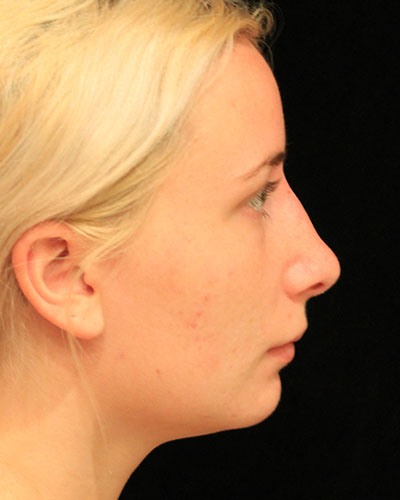 After rhinoplasty side Greenwich, CT