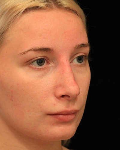 After rhinoplasty Greenwich, CT