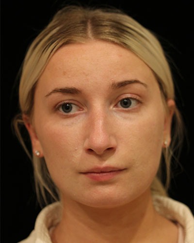 Before rhinoplasty Greenwich, CT