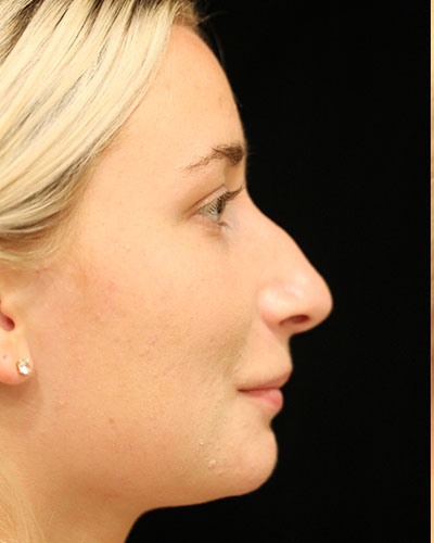 Before rhinoplasty side Greenwich, CT