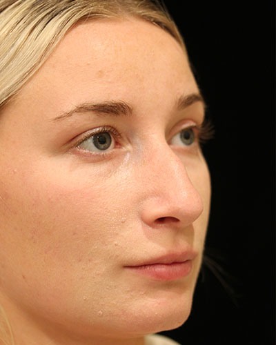 Before rhinoplasty angle Greenwich, CT