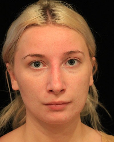 After rhinoplasty Greenwich, CT