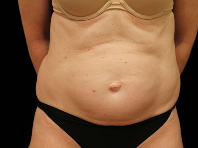 Before tummy tuck Greenwich, CT