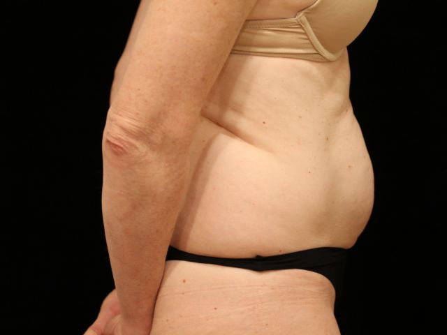 Before tummy tuck side Greenwich, CT