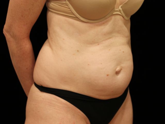 Before tummy tuck angle Greenwich, CT
