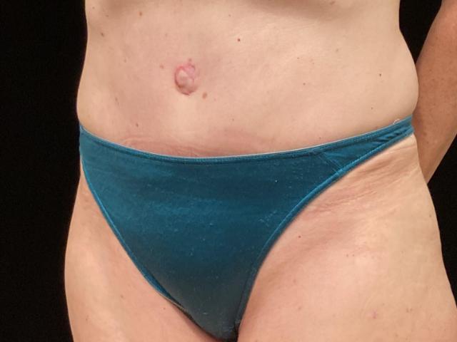 After tummy tuck angle Greenwich, CT