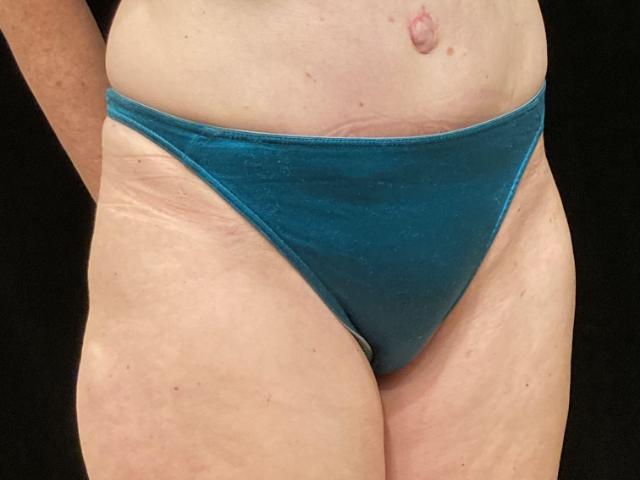 After tummy tuck angle Greenwich, CT