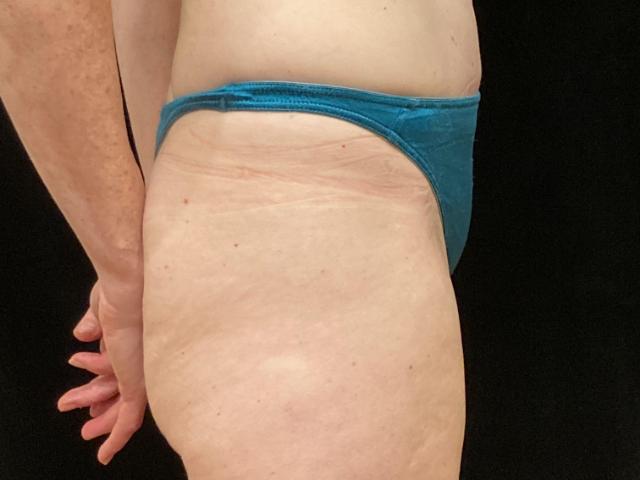 After tummy tuck side Greenwich, CT